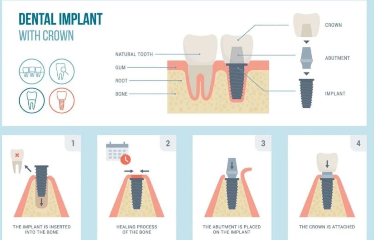 Clínica de Fort Worth Hace los Implantes Dentales Más Accesibles Mediante Gestión Estratégica