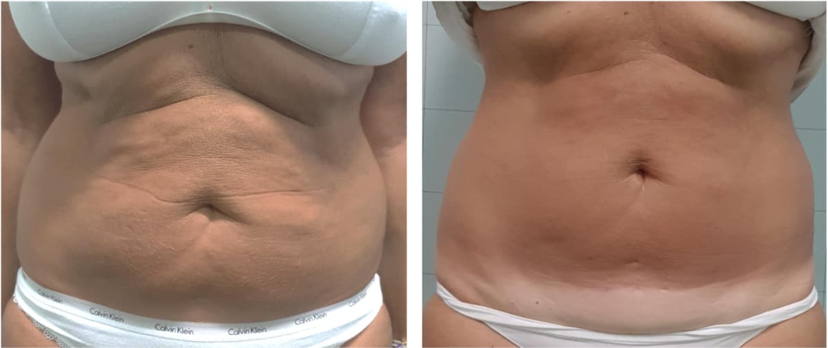 Ovation Med Spa Mejora sus Servicios de Moldeado Corporal con la Avanzada Tecnología BodyEstiq™ Onda Coolwaves®